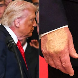 President Donald Trump's neck rash and hand makeup during the MLS Cup Champions Inter Miami CF event in the East Room of the White House on March 5, 2026 in Washington, DC.