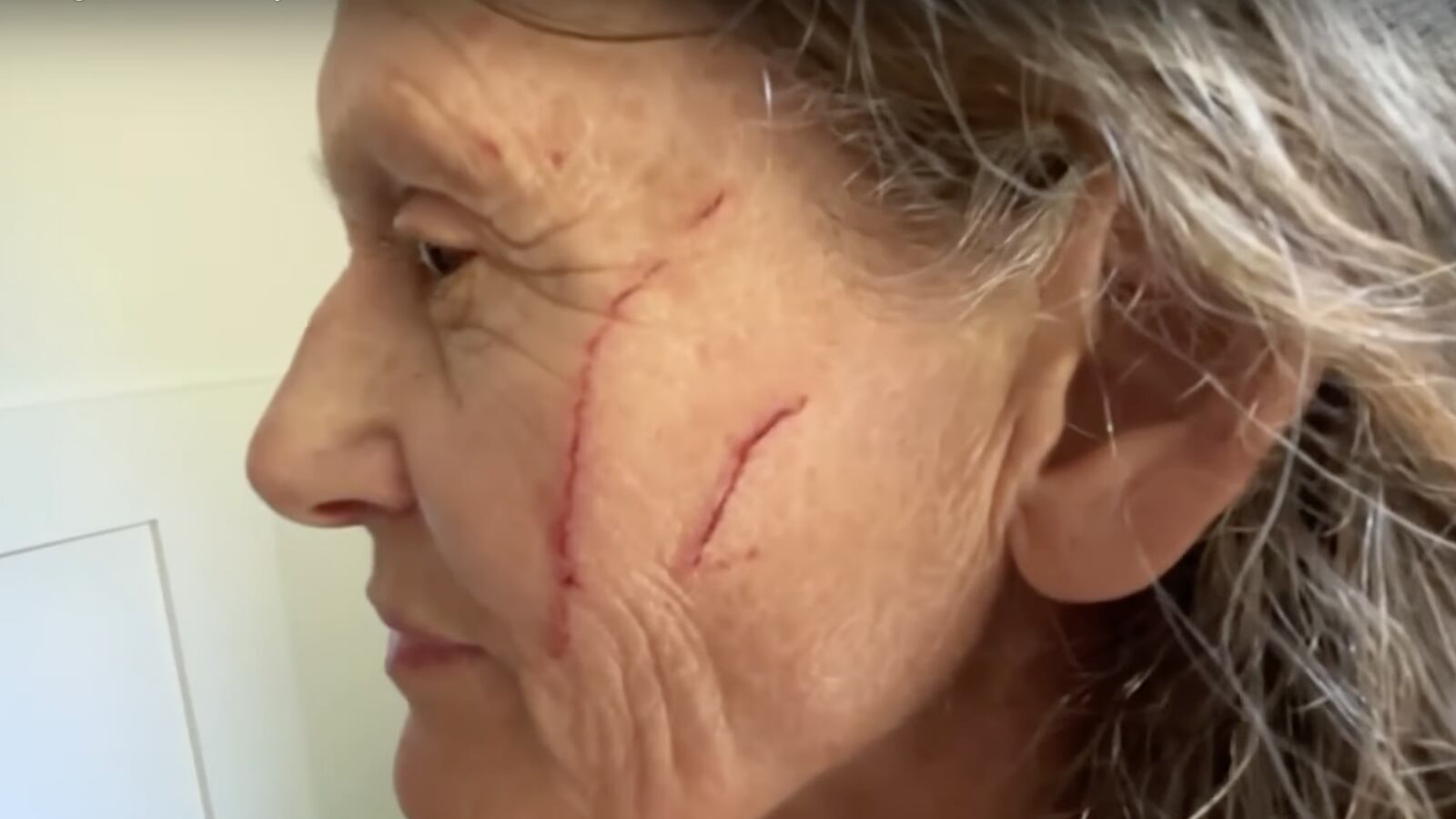 Katharine VanBuskirk's face injuries.