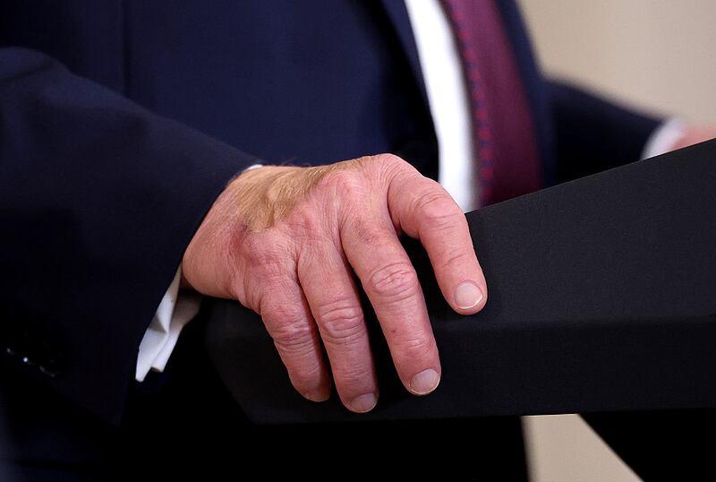 U.S. President Donald Trump's hand is seen as he holds a joint press conference with Israeli Prime Minister Benjamin Netanyahu in the State Dining Room at the White House on September 29, 2025.