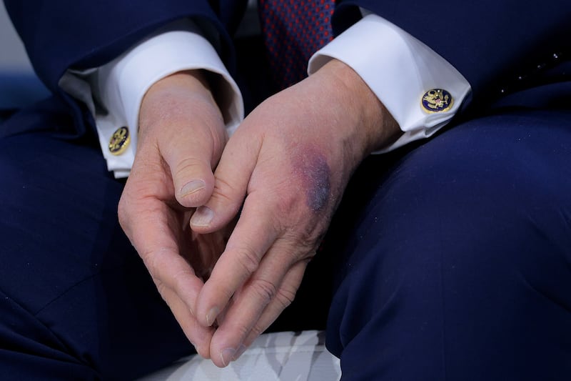 A bruise appears on the back of U.S. President Donald Trump's left hand during a signing ceremony for the “Board of Peace” at the World Economic Forum (WEF) on January 22 in Davos, Switzerland.