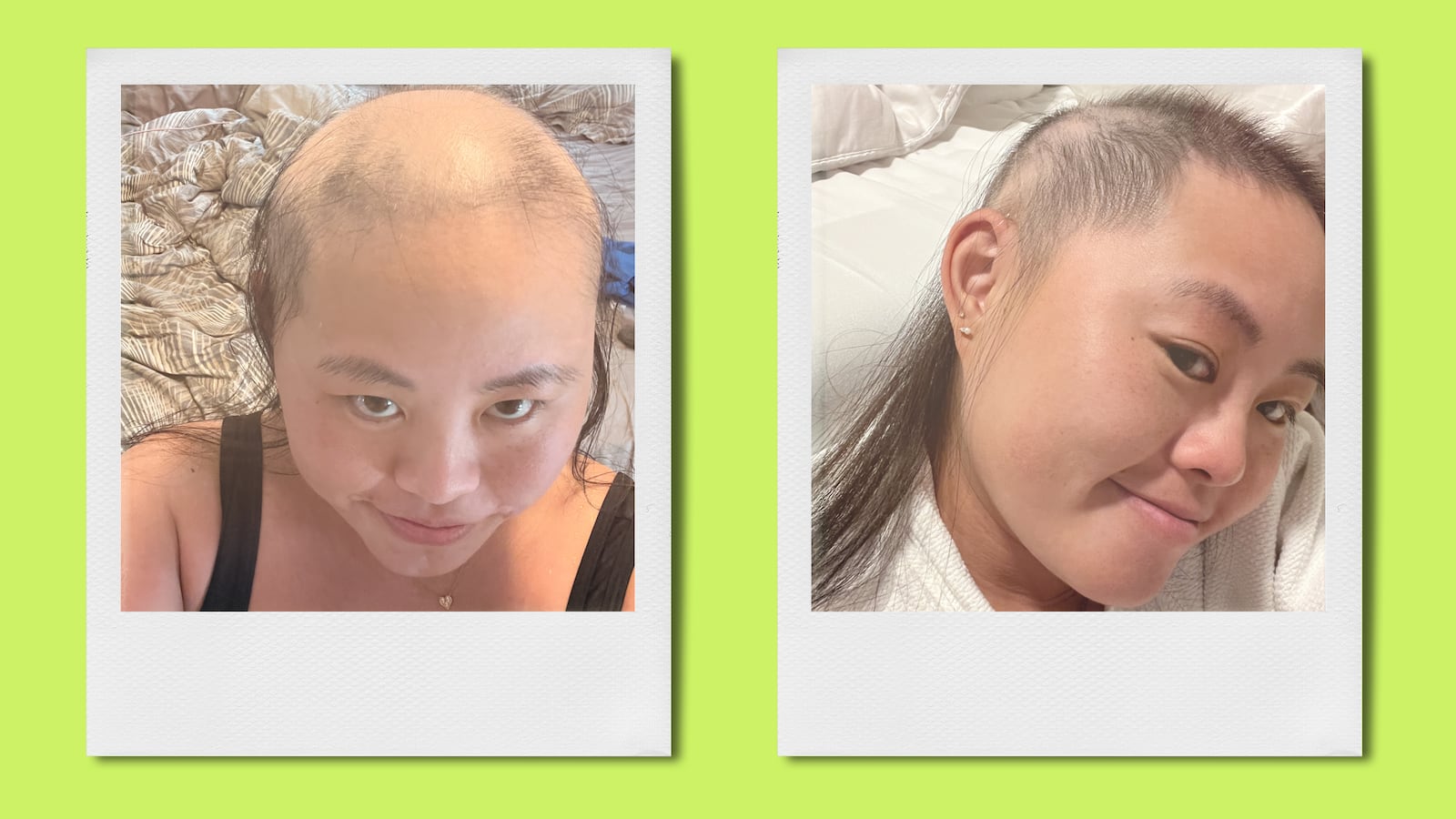 Kianna Chang hair loss before and after for Looker.