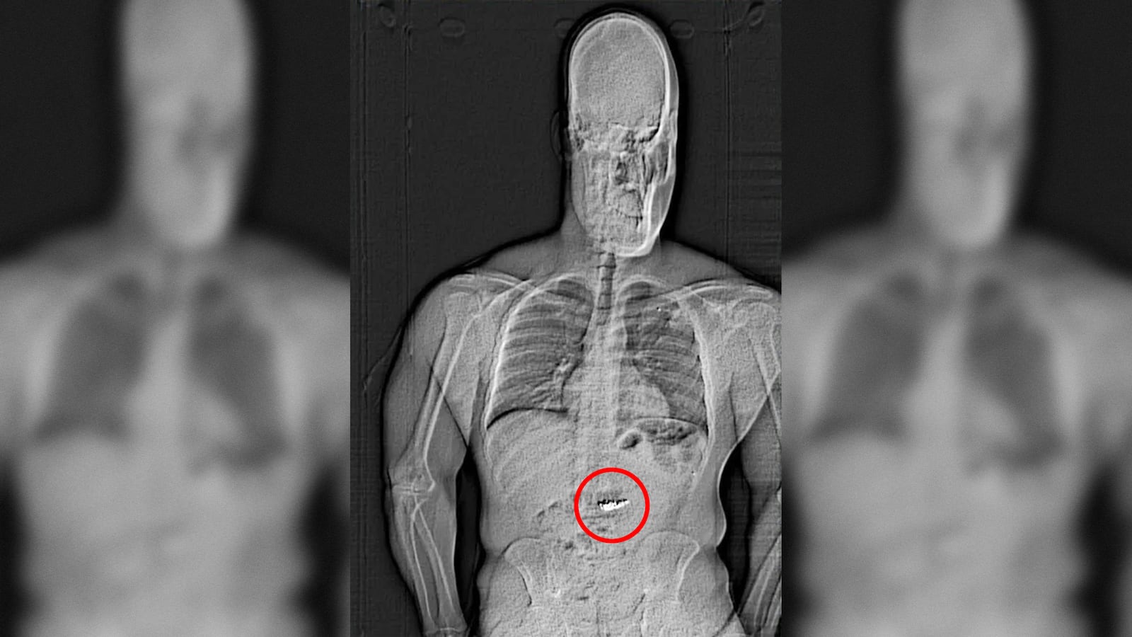Orlando police released an x-ray image that appeared to show a foreign object in the suspect's abdomen.