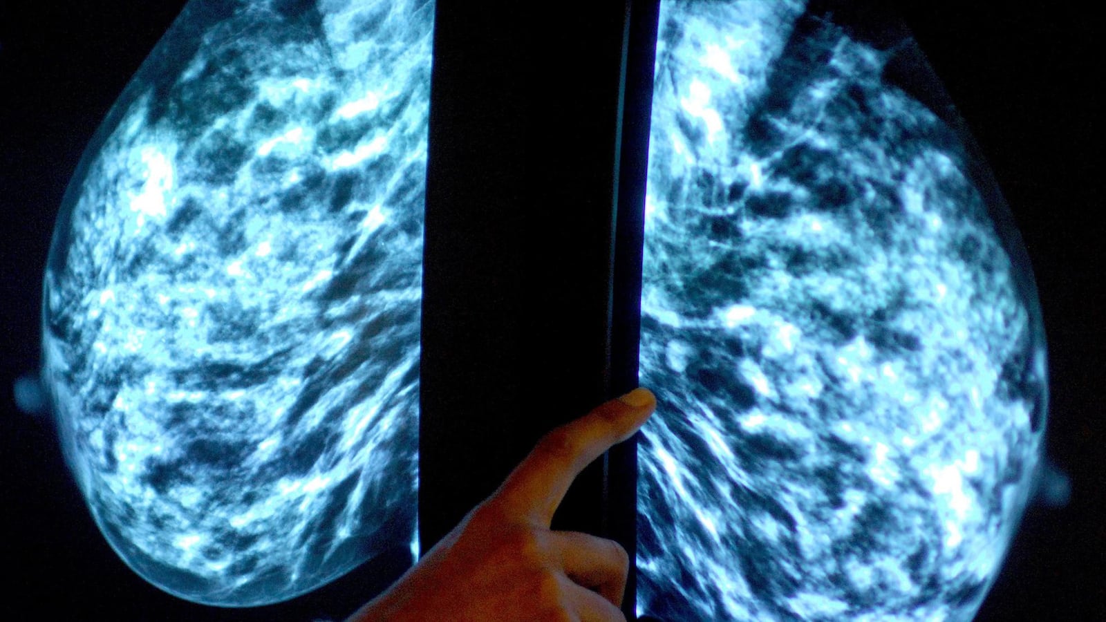 cheats/2013/03/28/scientists-unearth-gene-marker-for-cancer/130328-mammogram-cheat_m51wde