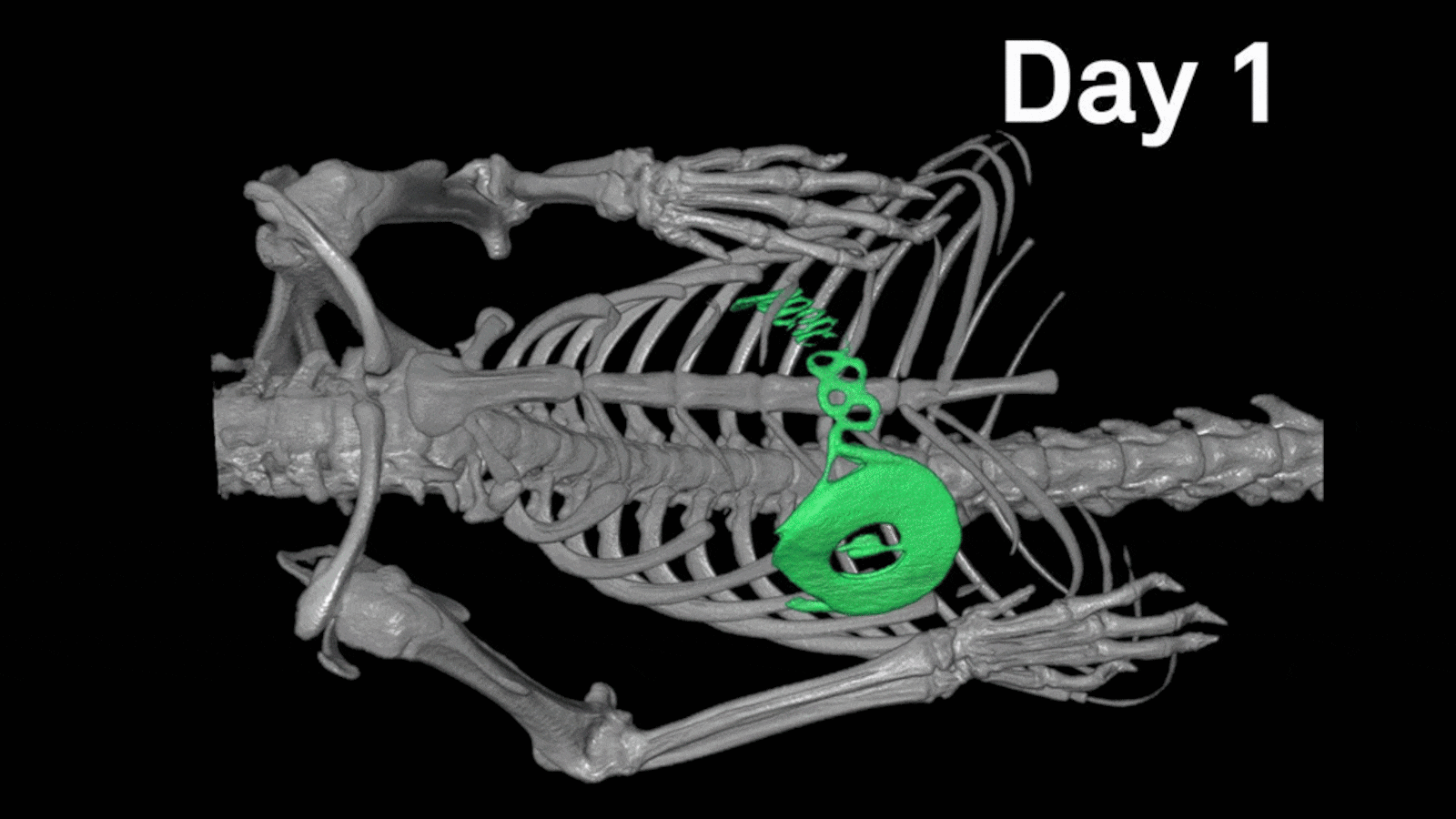 SM220525-Fauzia-dissolvable-pacemaker-tease_brdw6z