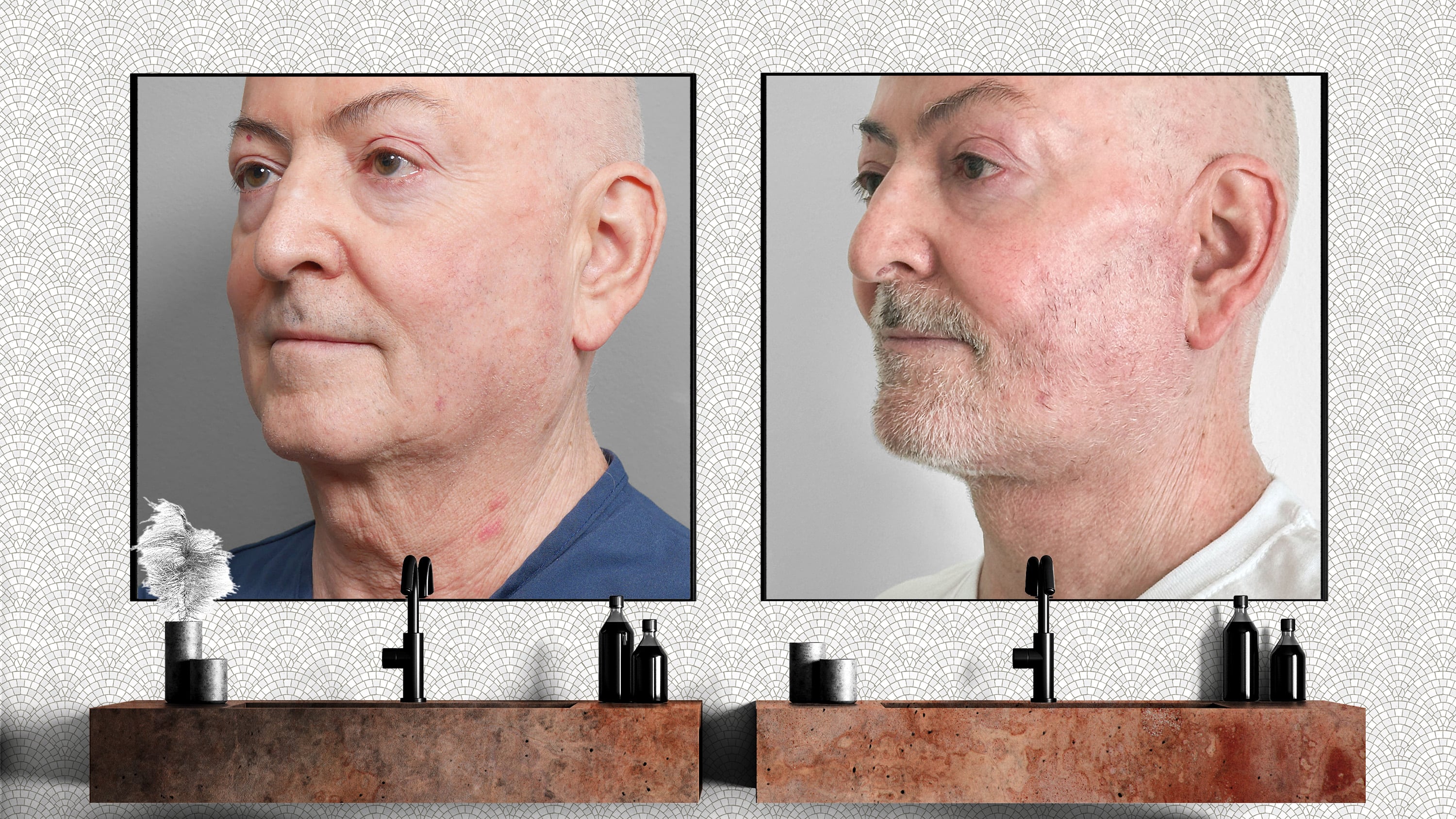 David's jawline transformation. 3/4 view