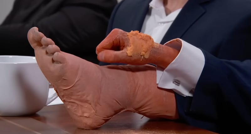 Shot of skit showing Donald Trump's bruised right hand and ankles. wollen