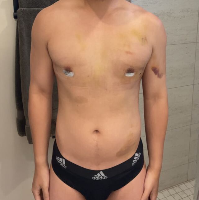 Jon Michael during recovery.