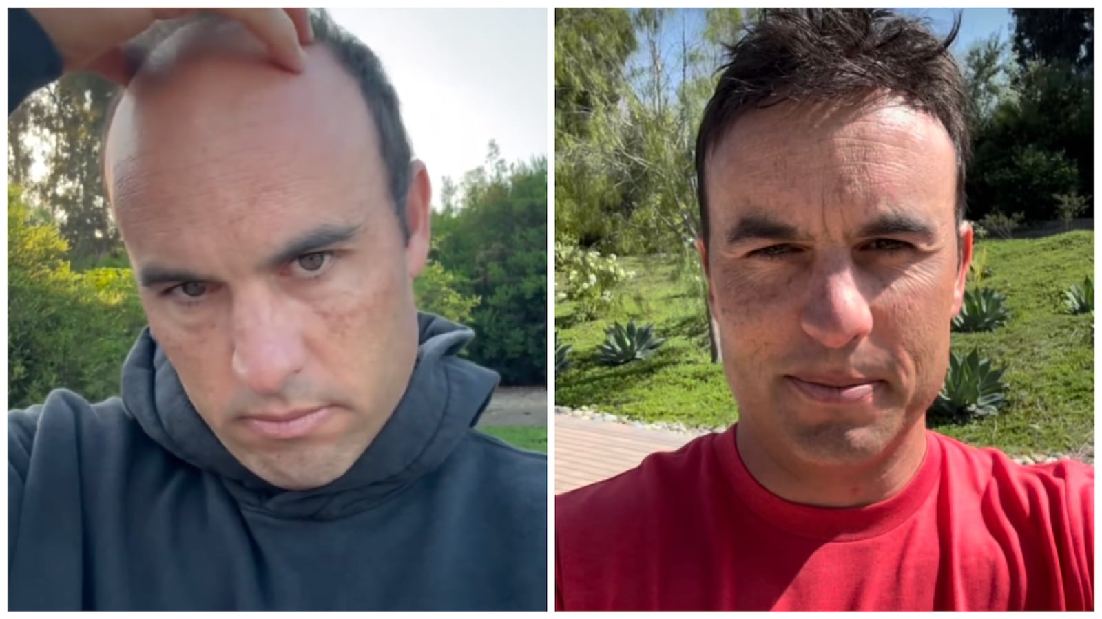 Landon Donovan before and after his hairpiece installation