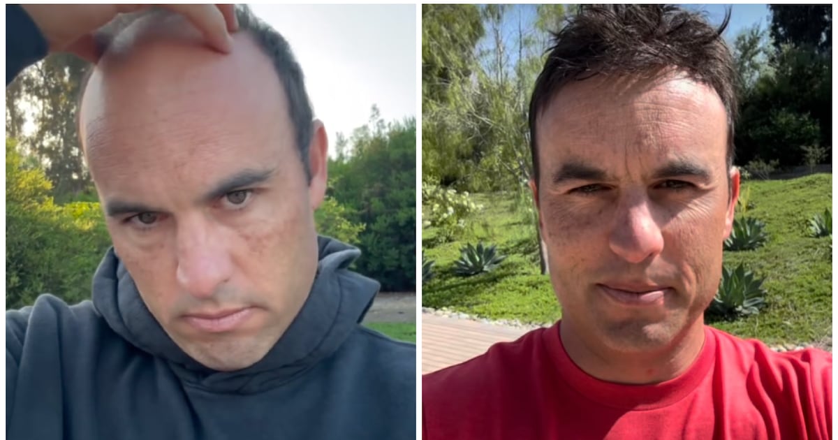 World Cup Star Posts Dramatic Hairpiece Before-and-After Photos