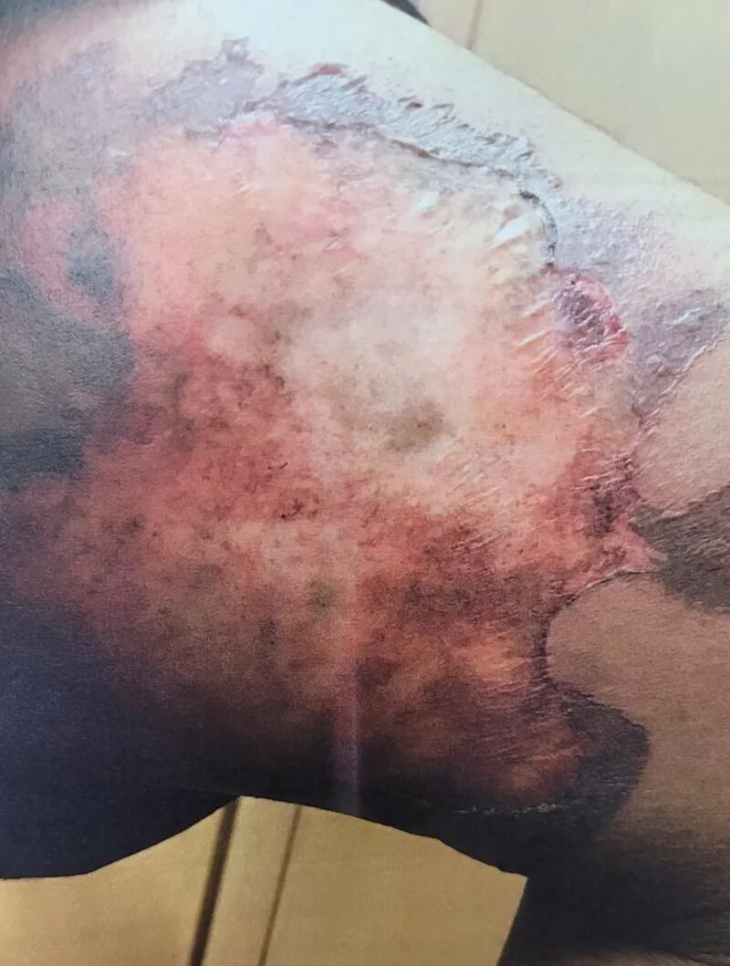 A photo of the burned thigh suffered by a 15-year-old migrant girl, obtained by PunchUp, which Eastman was accused of downplaying.