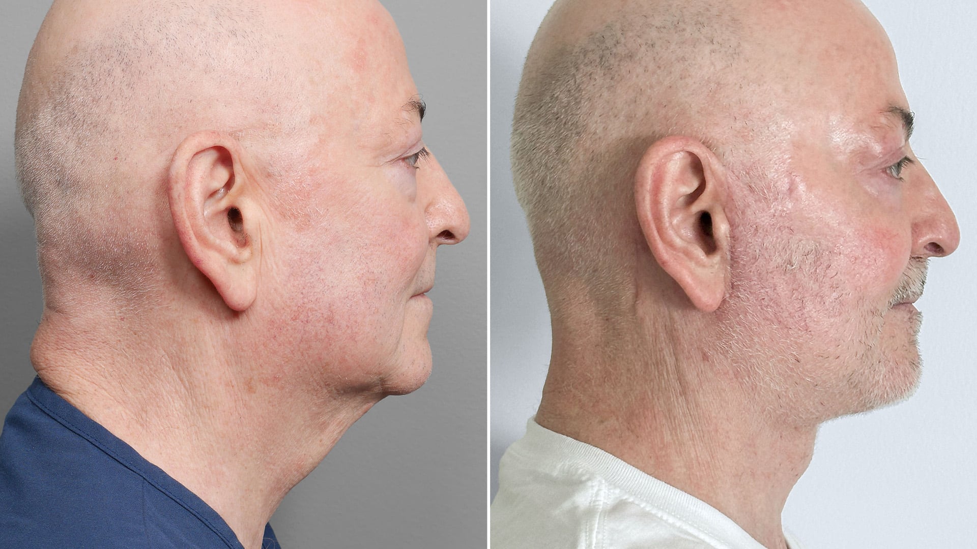 David's jawline before and after. Side view