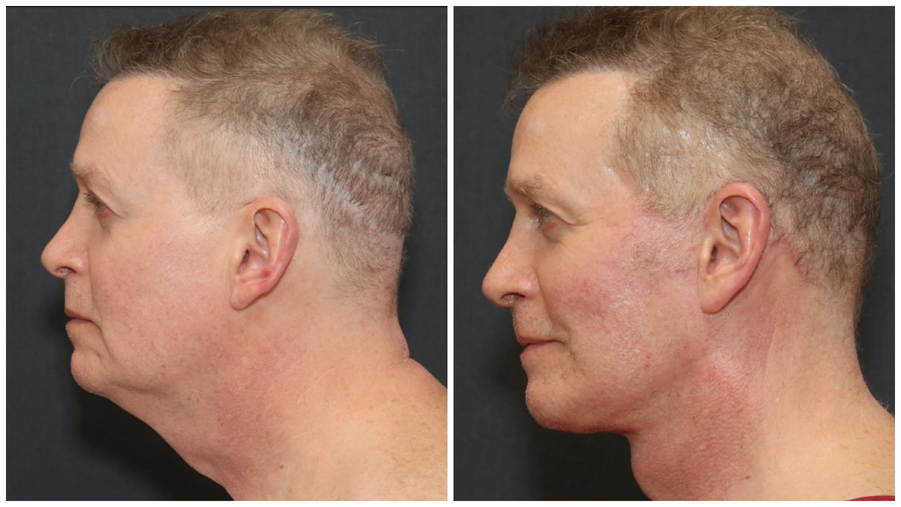 John Spaedy, 64, before getting plastic surgery on his face and neck; John, now 65, is almost completely healed