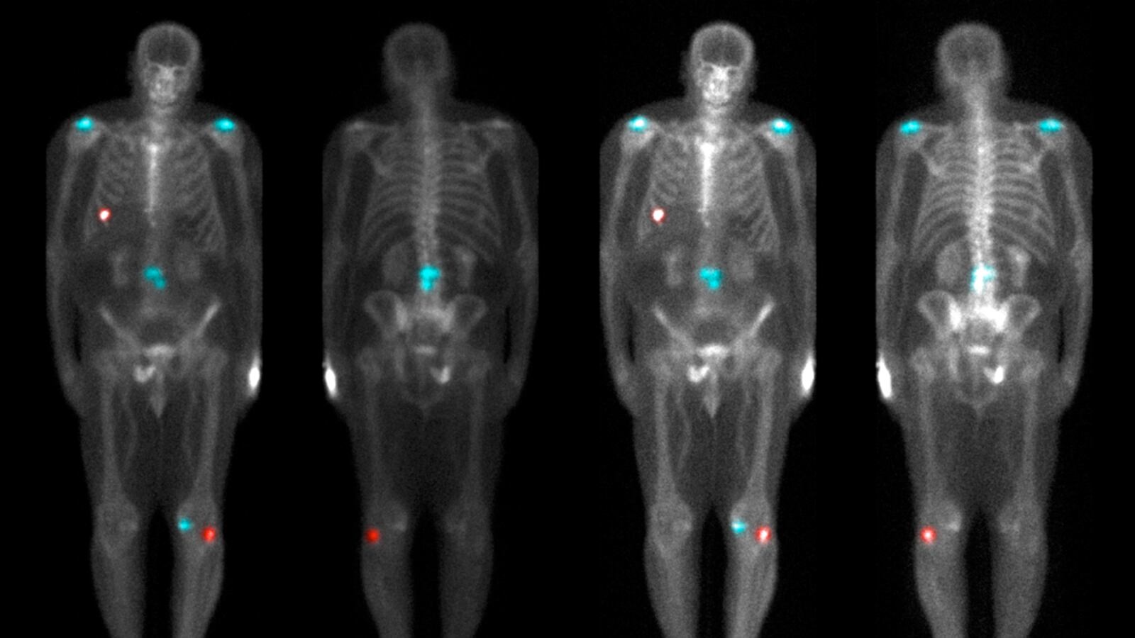 cheats/2011/10/06/panel-don-t-get-prostate-cancer-screenings/prostate-cancer-scan-cs_gyfraq
