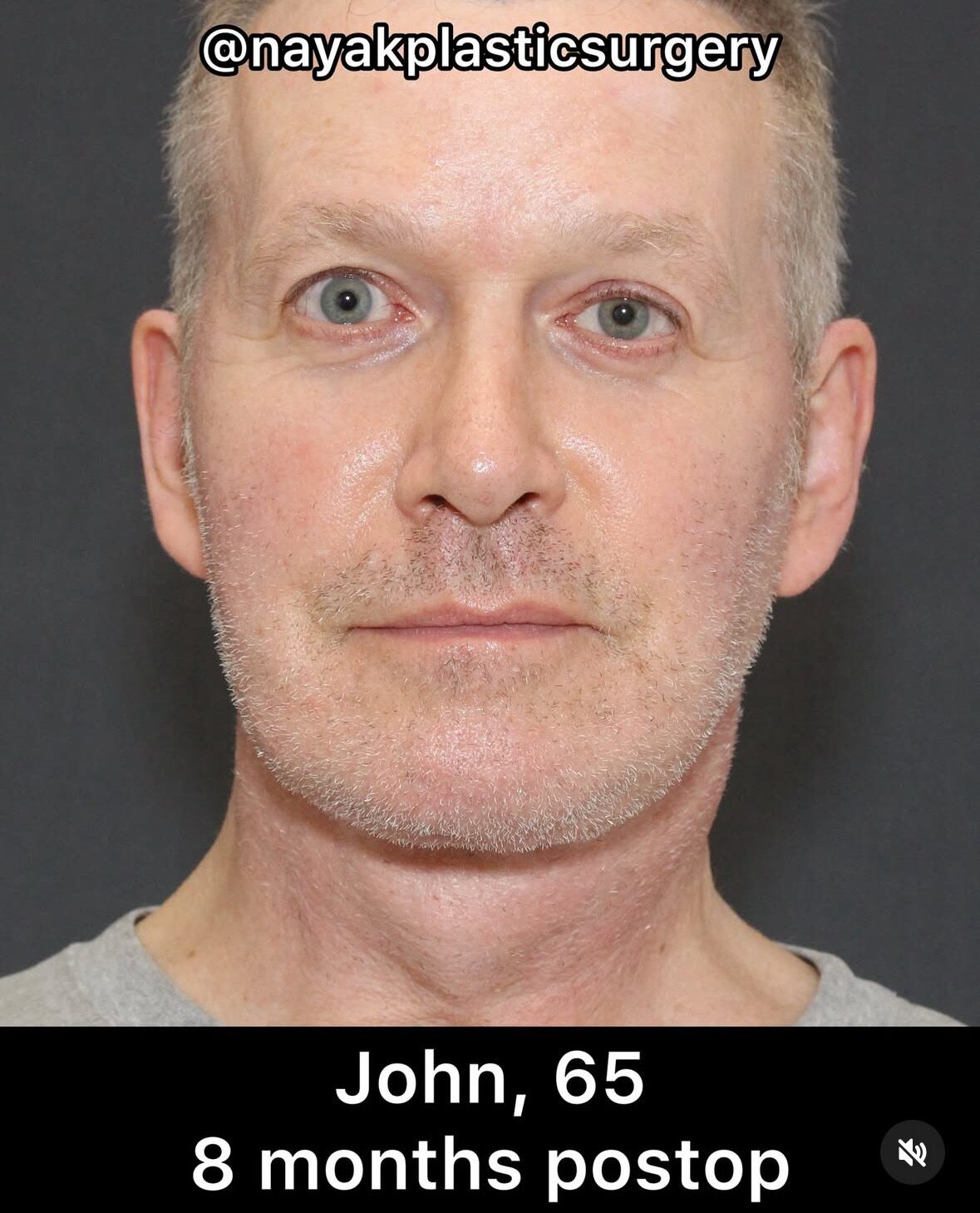 Photo of John Spaedy eight months post-operation.