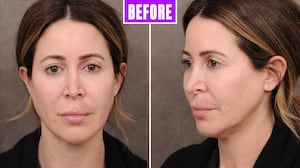 Britney Semler before her facelift, February 26, 2021.