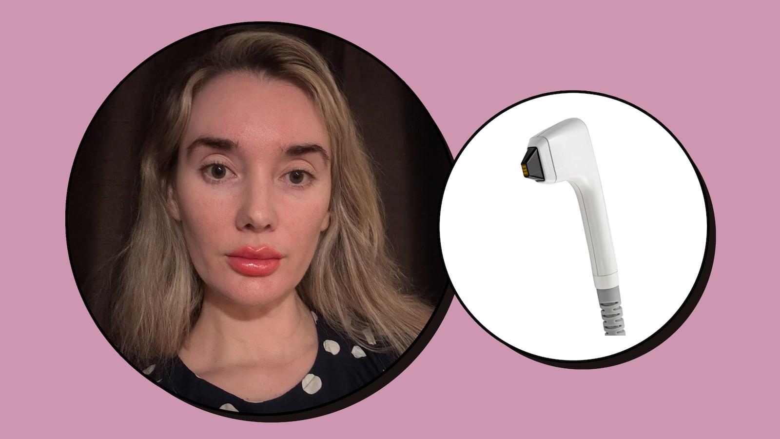 Sofwave before and after review