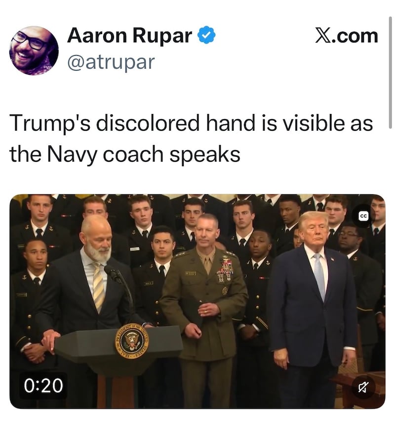 Trump's bruised hand was visible during the ceremony.