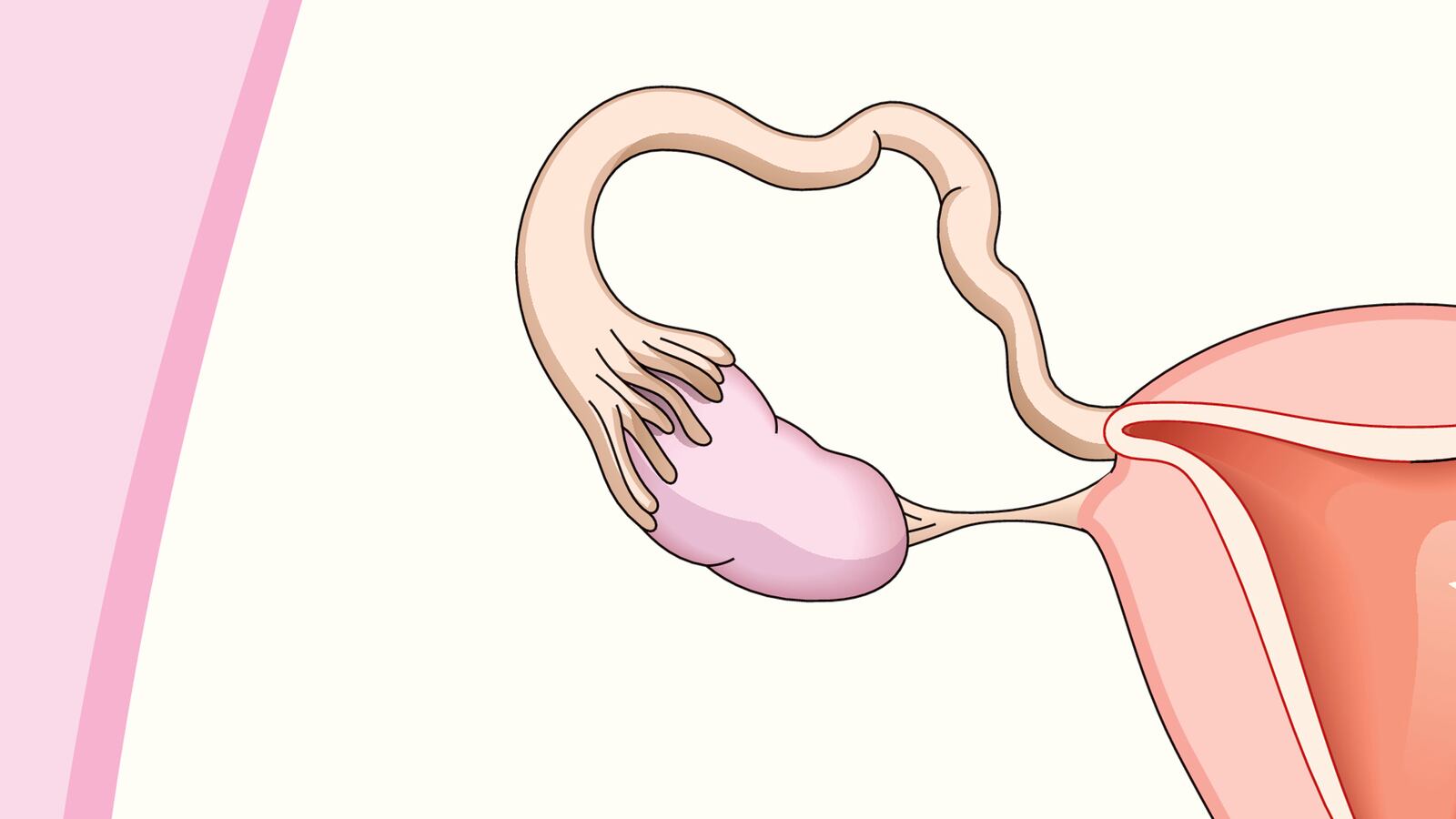 cheats/2014/02/24/women-remove-cancer-prone-ovaries/140224-ovarian-cancer-cheat_viqhcb