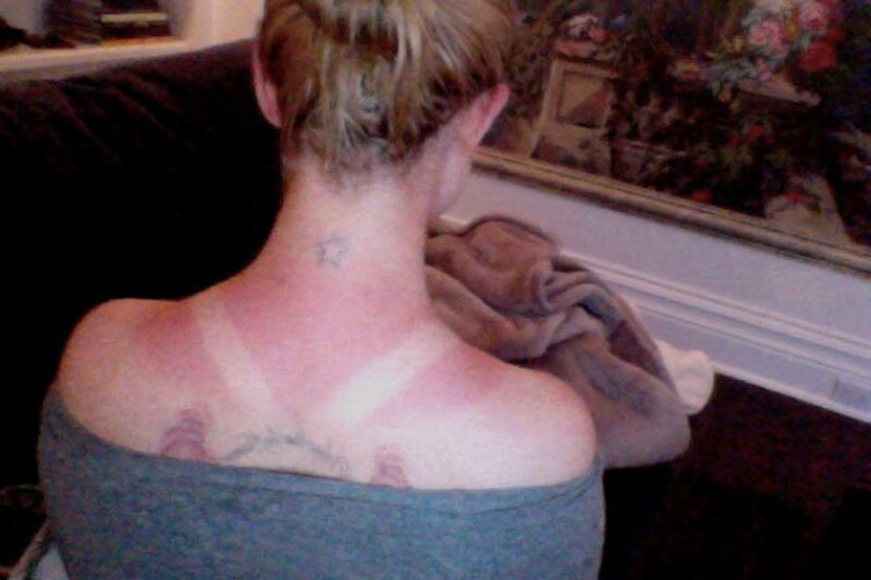 galleries/2011/07/04/celebrity-sunburns-kim-kardashian-simon-cowell-and-more/osbourne-worst-celebrity-sunburns_jsvxmo