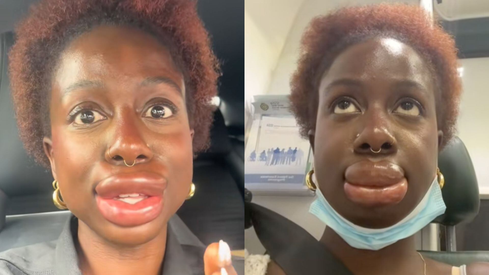 viral tiktok videos show woman's severe allergic reaction to lip filler dissolver