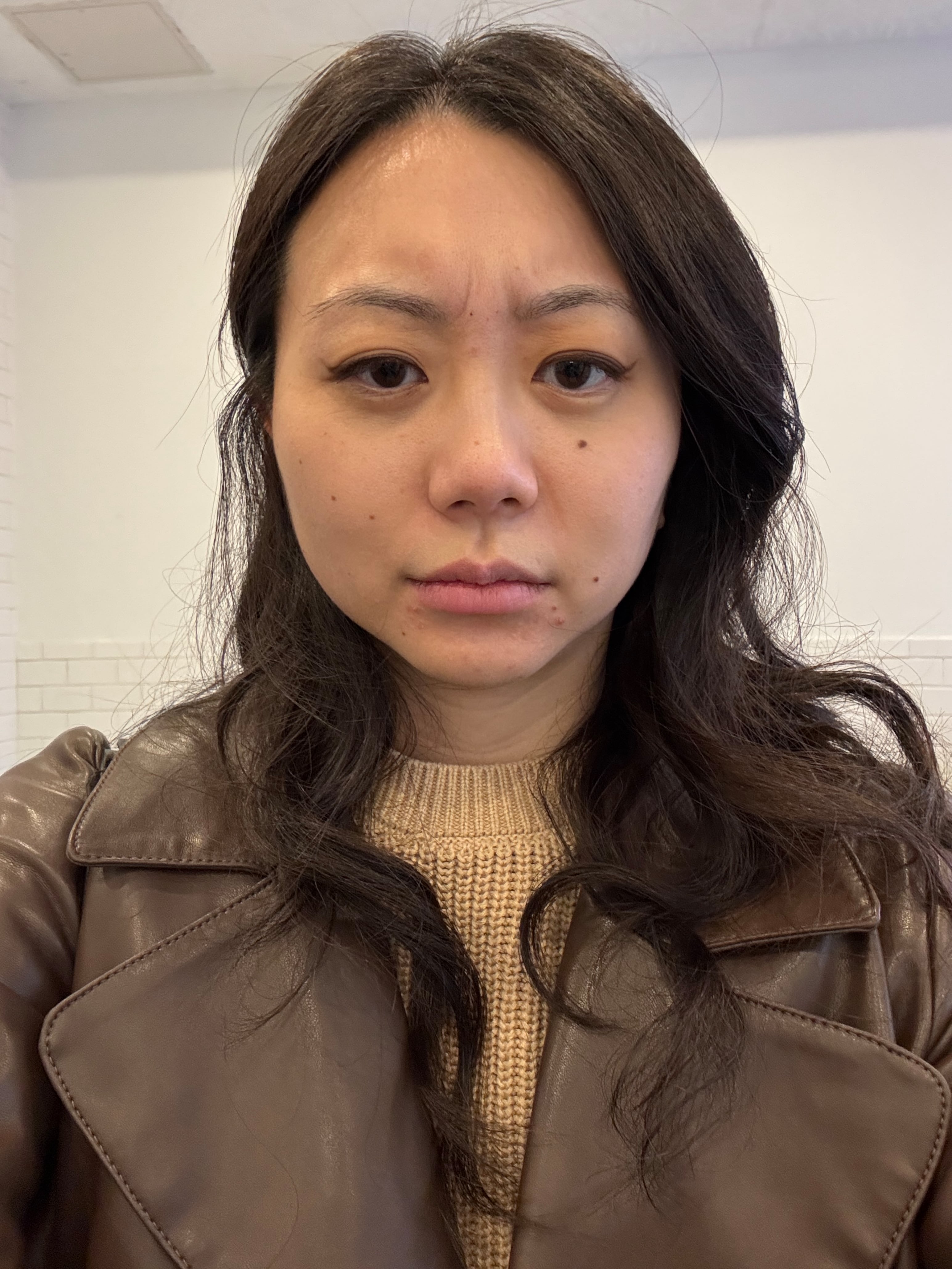 Frowning with baby botox day one