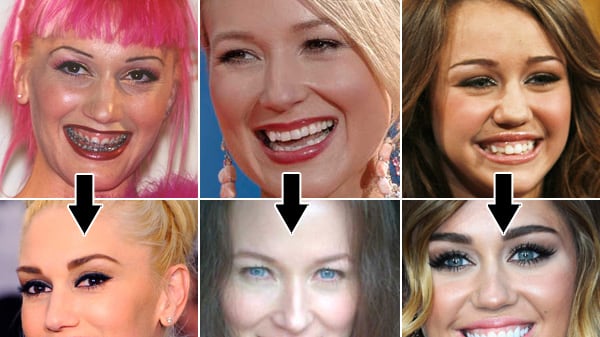 galleries/2012/06/08/jewel-lindsay-lohan-more-stars-who-fixed-their-teeth-photos/celebrity-teeth-fixers-tease_xkfodn