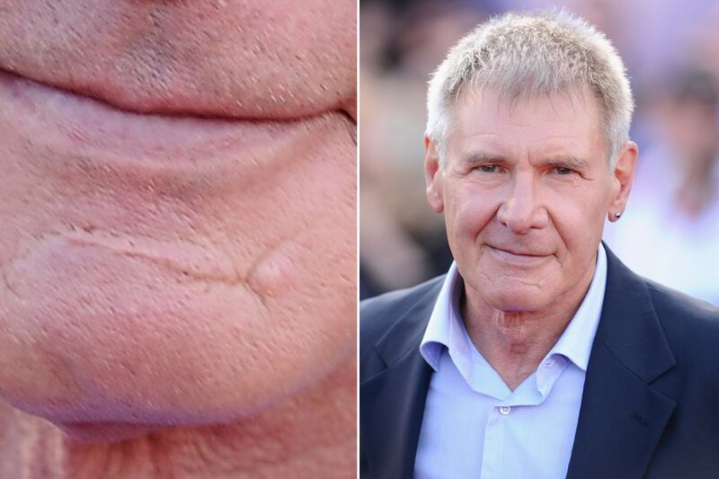 galleries/2011/12/01/kate-middleton-and-other-stars-with-scars-photos/stars-scars-ford_glggpu