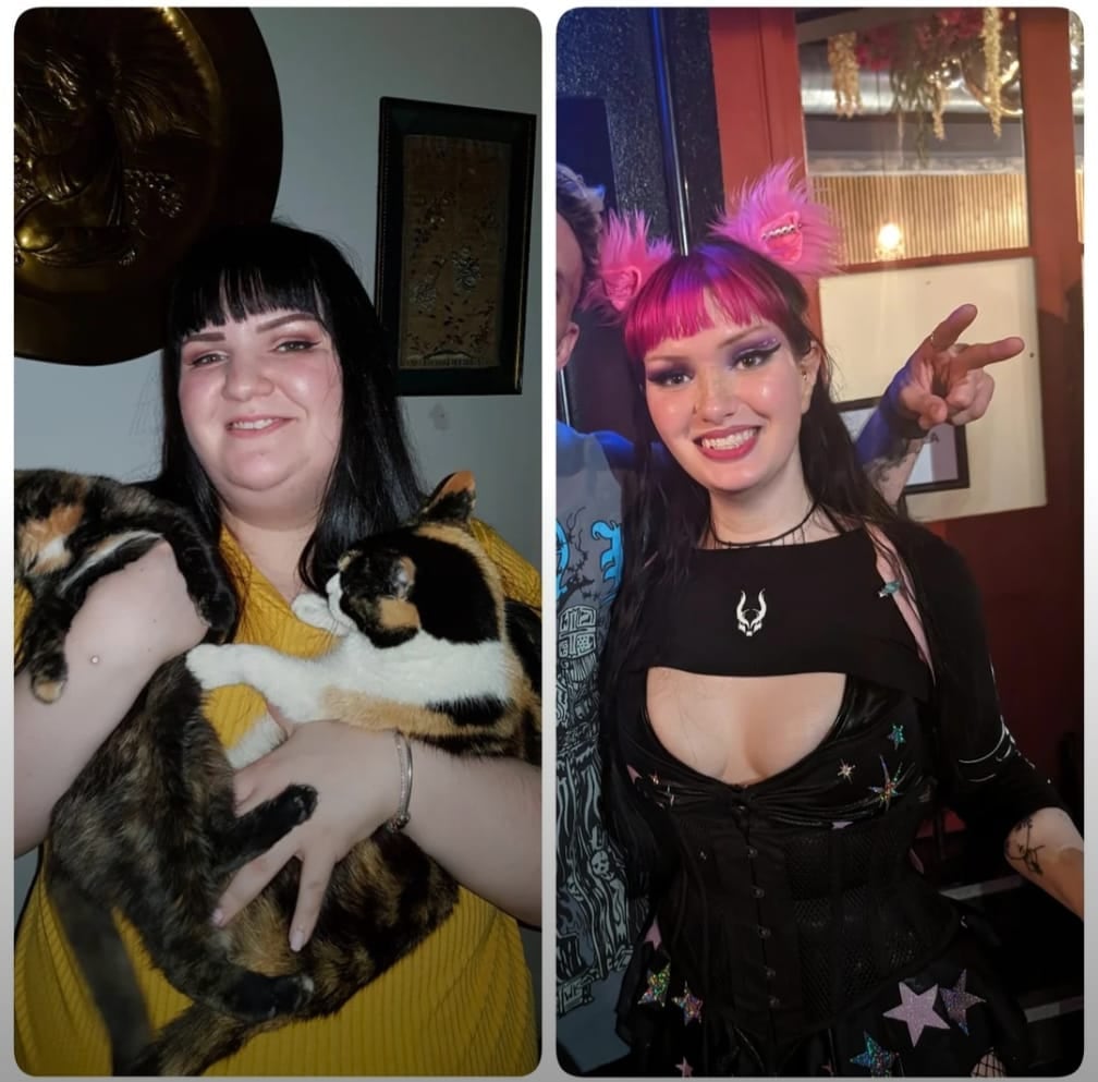 A before-and-after of the subject. Winter had a total of ten cosmetic surgeries to fix her body dysmorphia.