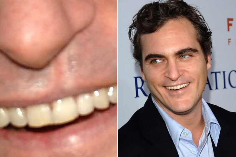 galleries/2011/12/01/kate-middleton-and-other-stars-with-scars-photos/stars-scars-phoenix_ve581l