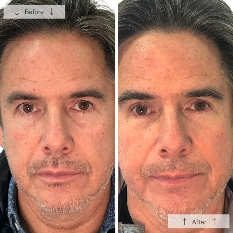 Omnilux Men LED Light Therapy Mask Before and After Review