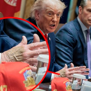 Donald Trump's bruised hand.