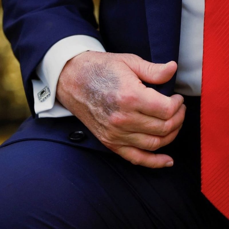 Trump hand
