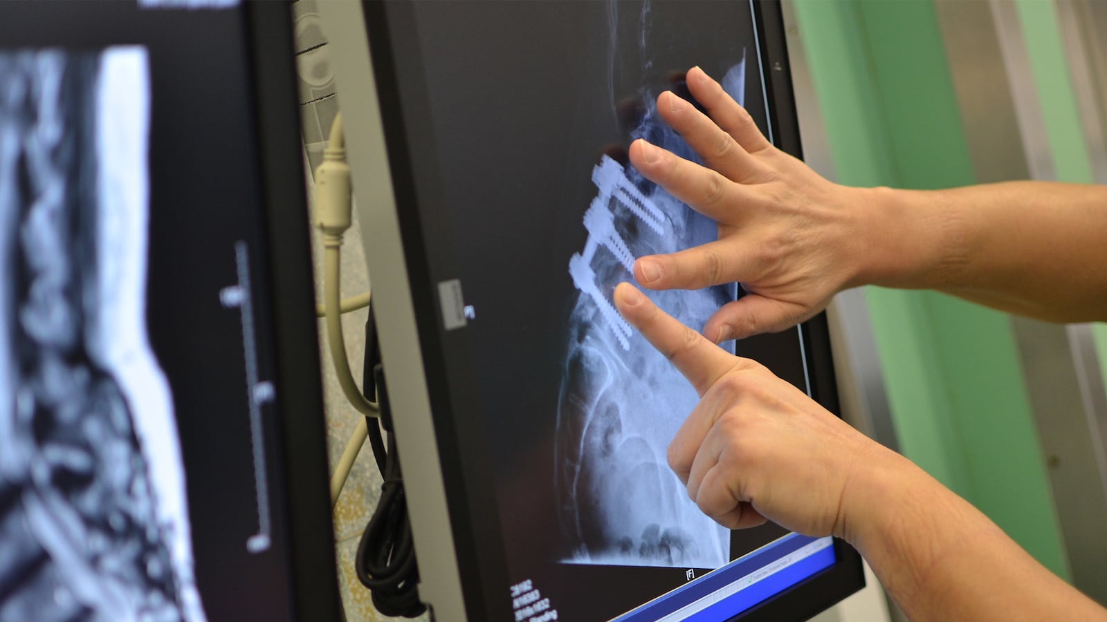 articles/2014/11/03/patients-screwed-in-spine-surgery-scam/141102-cir-medical-scam-tease_mukxv0