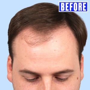 Jordan went through hair transplant surgery with Dr. Gary Linkov at Linkov Hair Surgery in New York City.