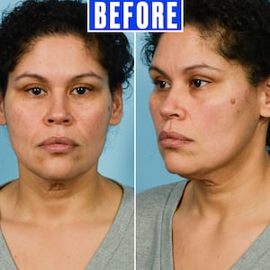 A bride-to-be underwent a facelift after 60 lb weight loss