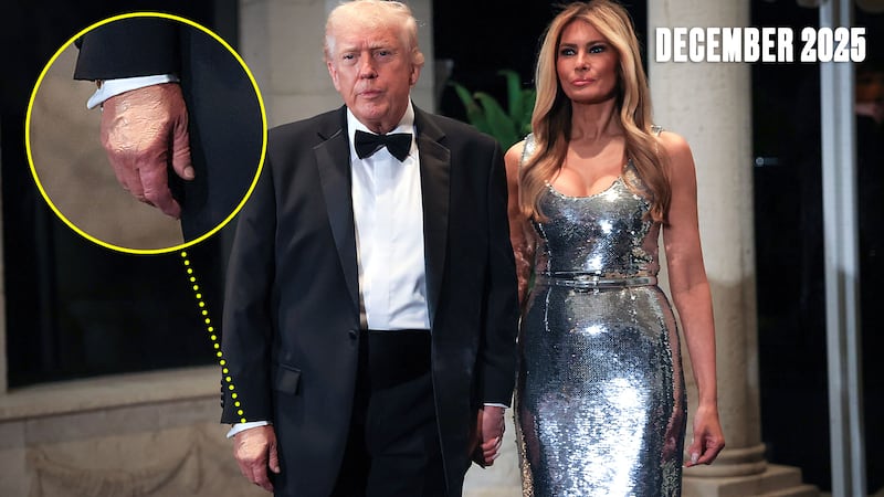 The makeup on President Donald Trump's hand as he partied on New Year's Eve.