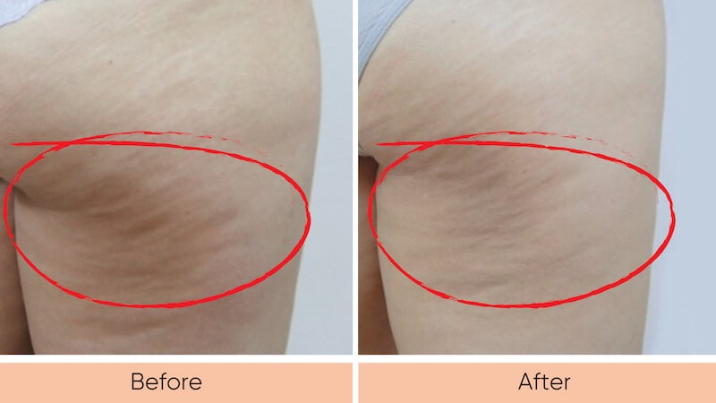 Before and after leg skin from Sensifirm Anti-Cellulite Skin Tightening usage.