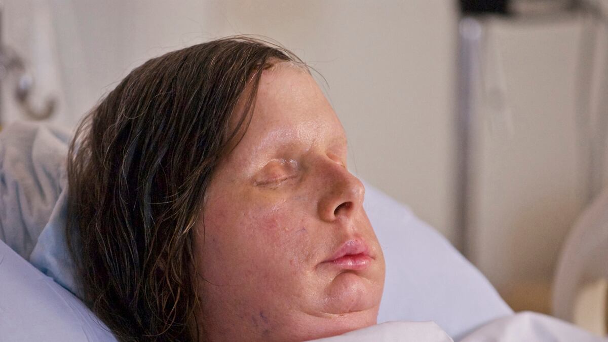 cheats/2011/08/11/chimp-attack-victim-gets-new-face/charla-nash-face-transplant-chimpanzee-attack-cheat_i0bdza