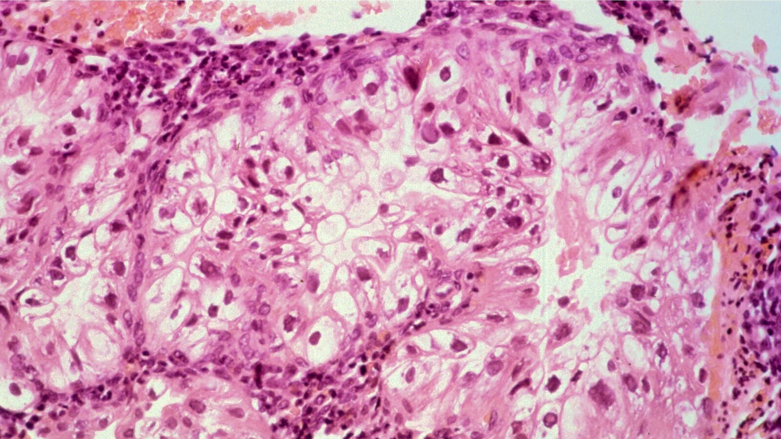 cheats/2017/01/23/cervical-cancer-deadlier-in-u-s-than-thought-death-toll-cancer/170123-cervical-cancer-study-cheat_vk0qqz