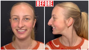 "Before" photos of Dr. Kassir's rhinoplasty patient, Jacqueline.