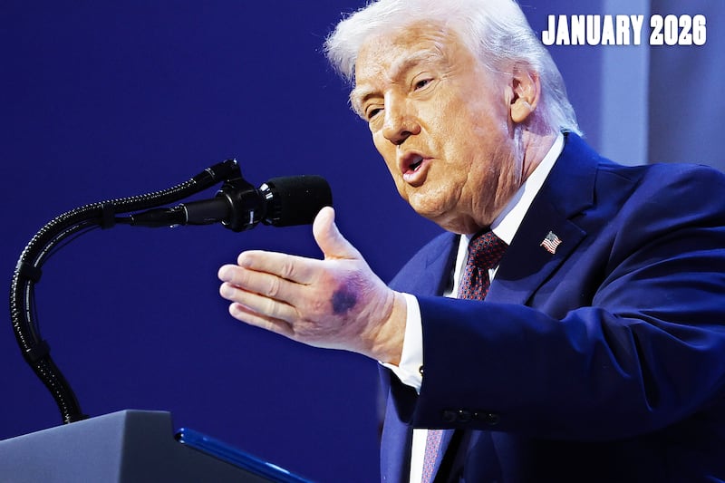 A bruise can be seen on the back of President Donald Trump's left hand during a signing ceremony for the “Board of Peace” at the World Economic Forum (WEF) on Jan. 22, 2026 in Davos, Switzerland.