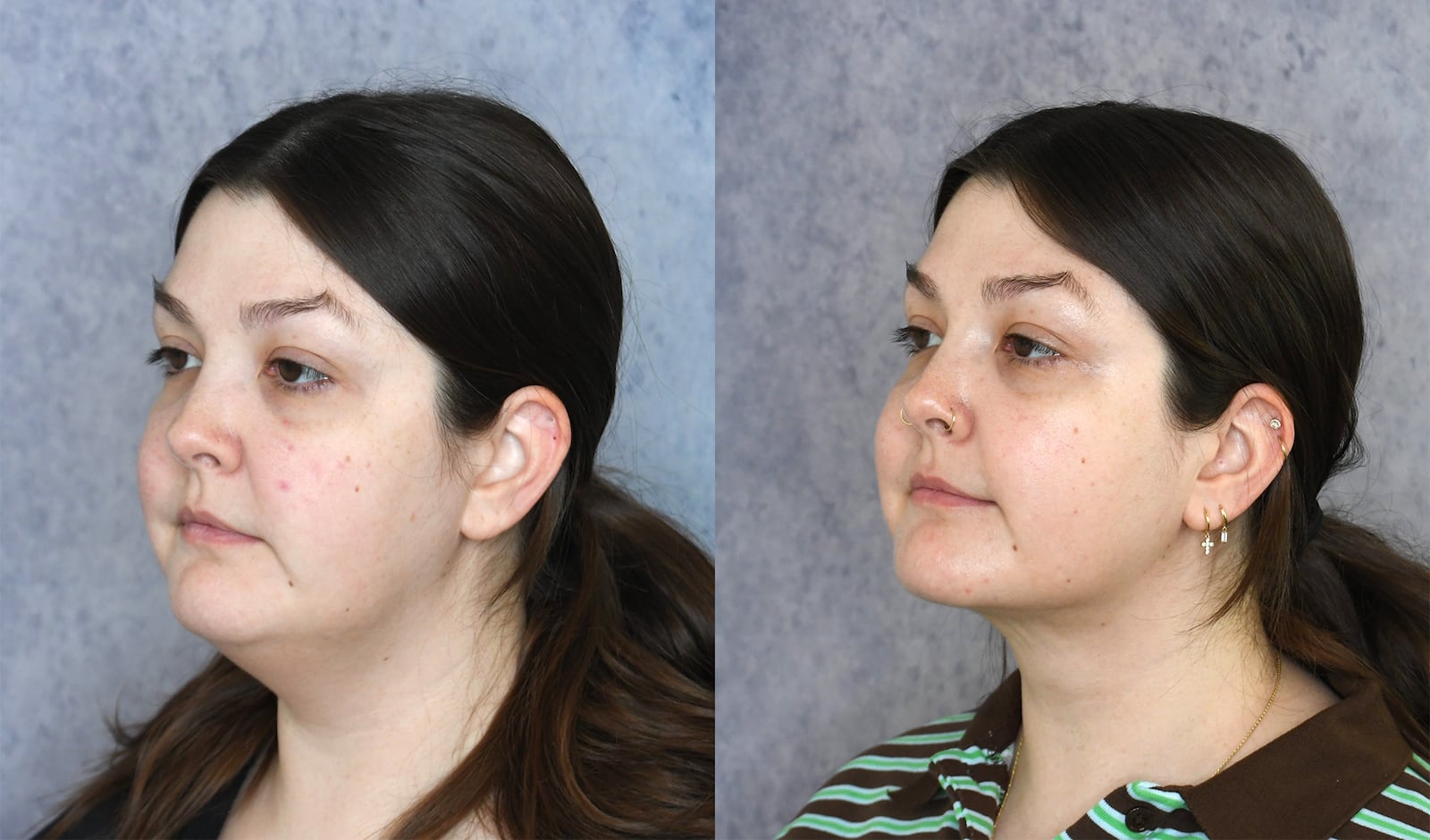 A photo illustration of chin lipo suction before and after for the Looker.