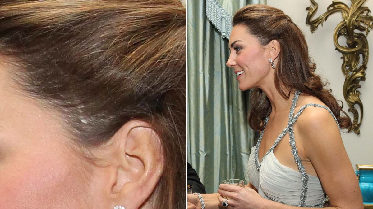 galleries/2011/12/01/kate-middleton-and-other-stars-with-scars-photos/stars-scars-middleton-tease_tx43qh