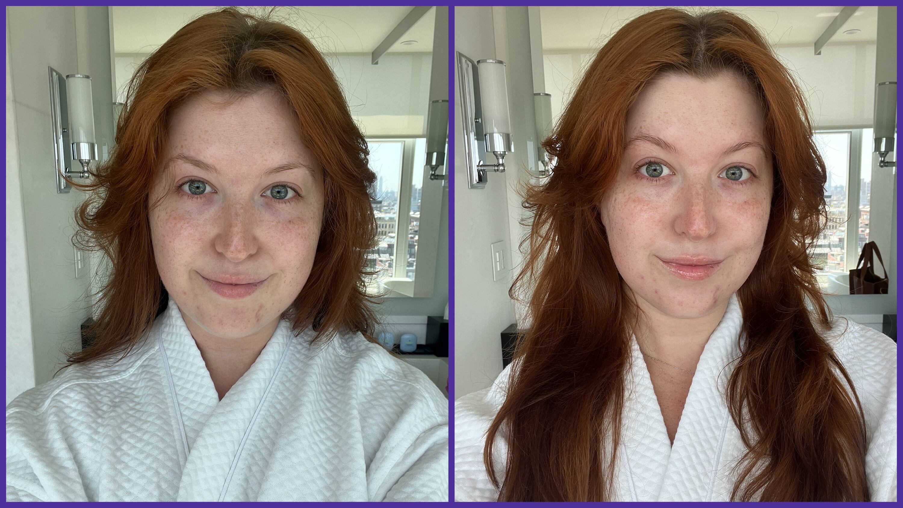 Mary Honkus before and after pictures of buccal fat removal