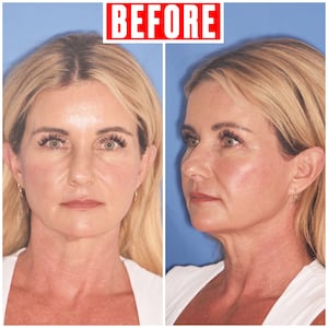 Chari Pack, 51, gets facelift after kids leave home.