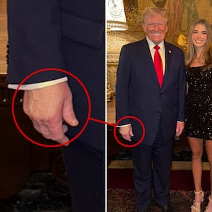Donald Trump with granddaughter Kai in November 2024. Discoloration can be seen in Trump's right hand.