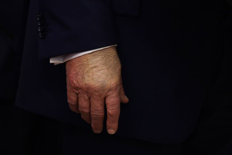 WASHINGTON, DC - SEPTEMBER 02: A detailed view of the hand of U.S. President Donald Trump as he speaks in the Oval Office at the White House on September 2, 2025 in Washington, DC. Following days of speculation about his health from users on social media, President Trump made his first public appearance in a week to announce the moving of Space Command headquarters from Colorado to Alabama.