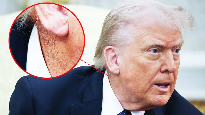 Donald Trump with an inset image of the rash and coverup on his neck