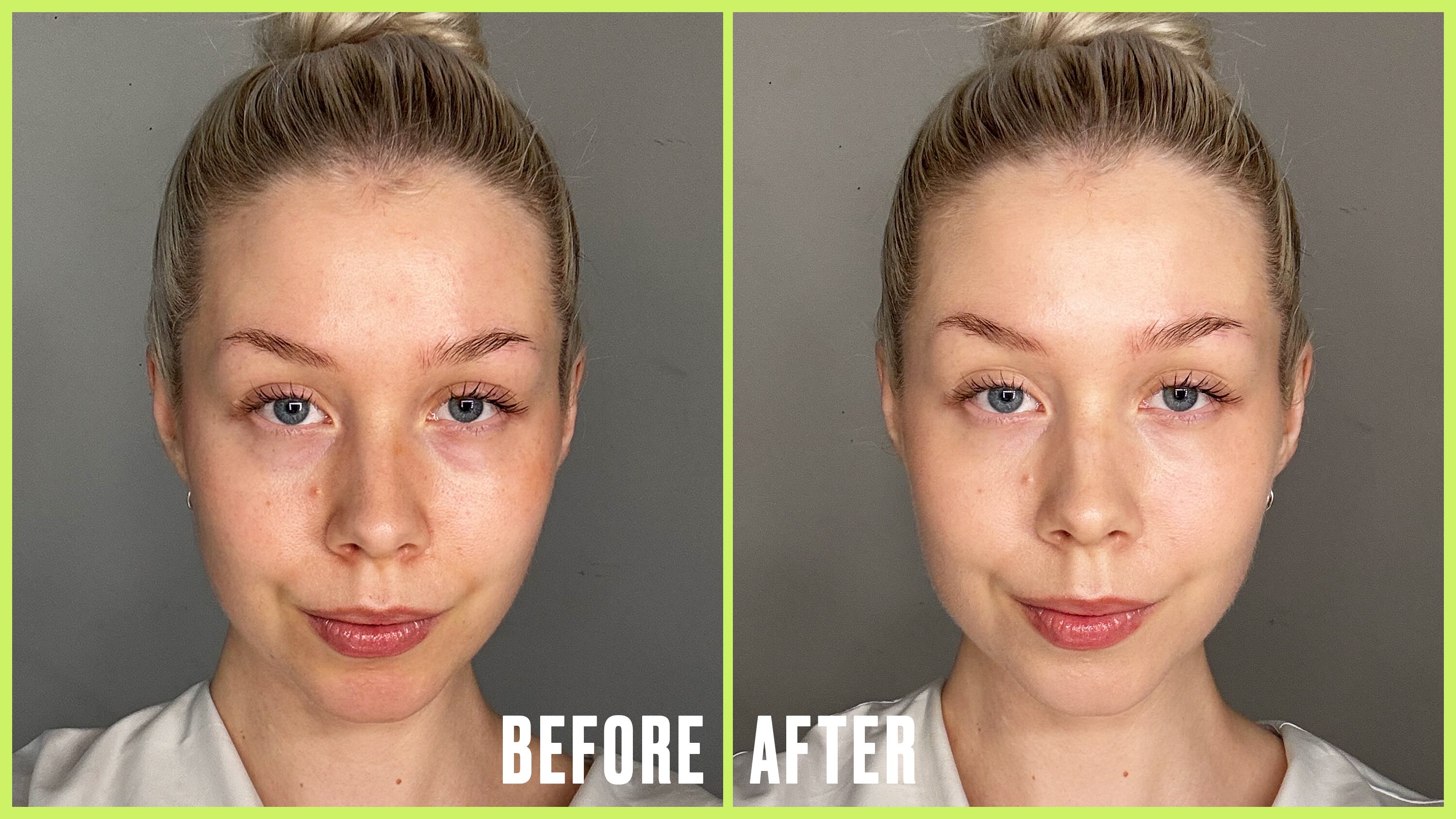 Before and After of Roosa Rahkonen using makeup to conceal veins.