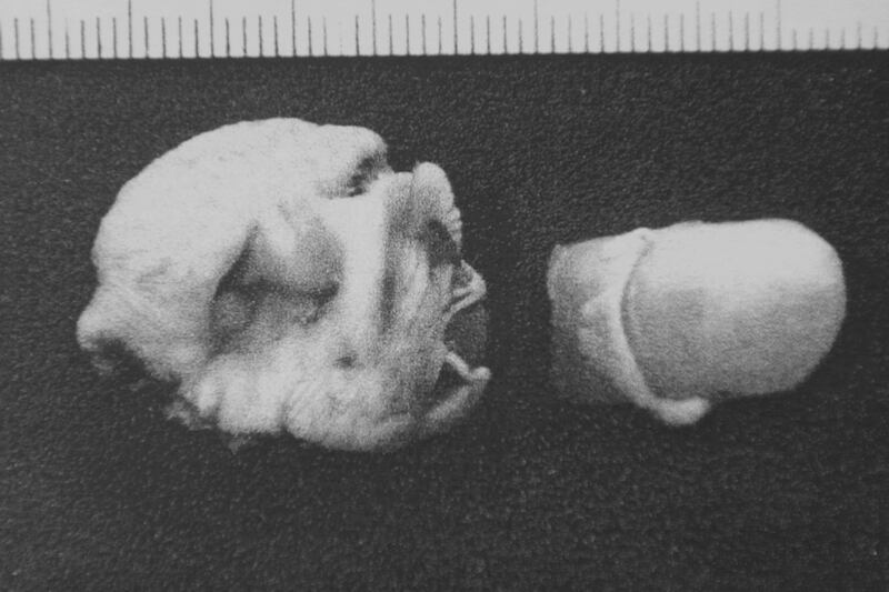 galleries/2012/07/18/needle-found-in-delta-sandwiches-and-more-gross-things-found-in-food/grossest-things-found-in-food-finger_les4eb